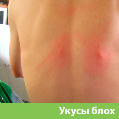 Укусы блох в Бердске