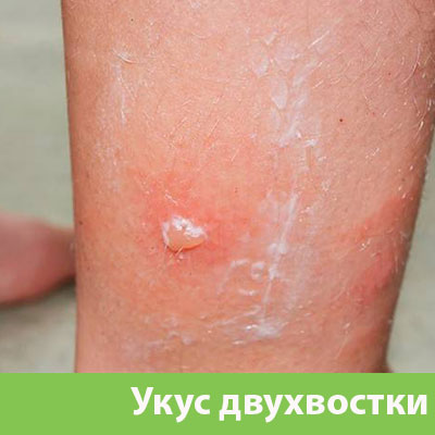 Укус двухвостки в Бердске