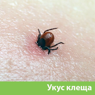 Укус клеща в Бердске