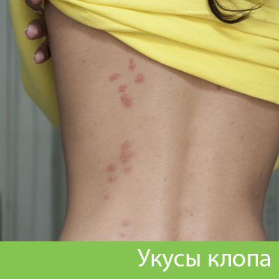 Профессиональное уничтожение клопов в Бердске